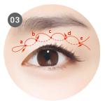 Sutures create folds through the eyelid