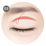 Suturing at the muscle lift and eyelid