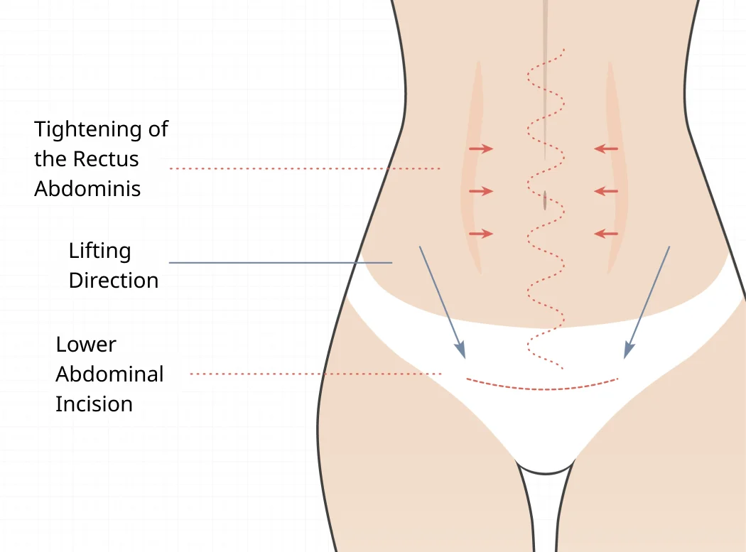 Abdominal Lift Surgery Diagram