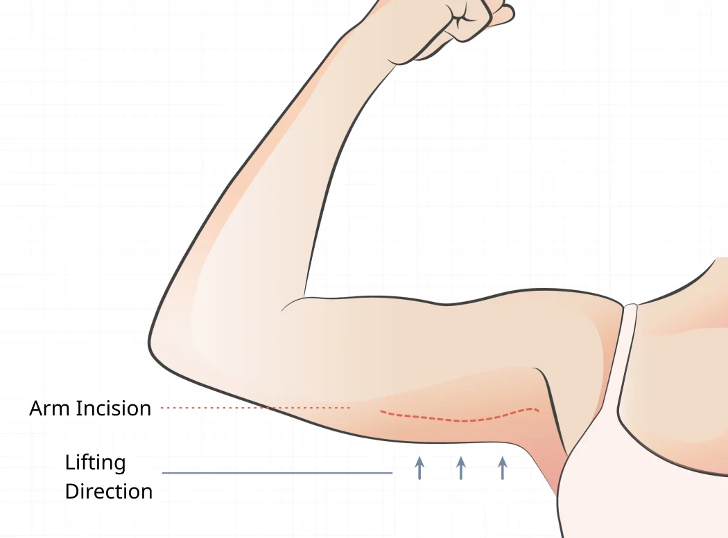 Arm Lift Surgery Diagram