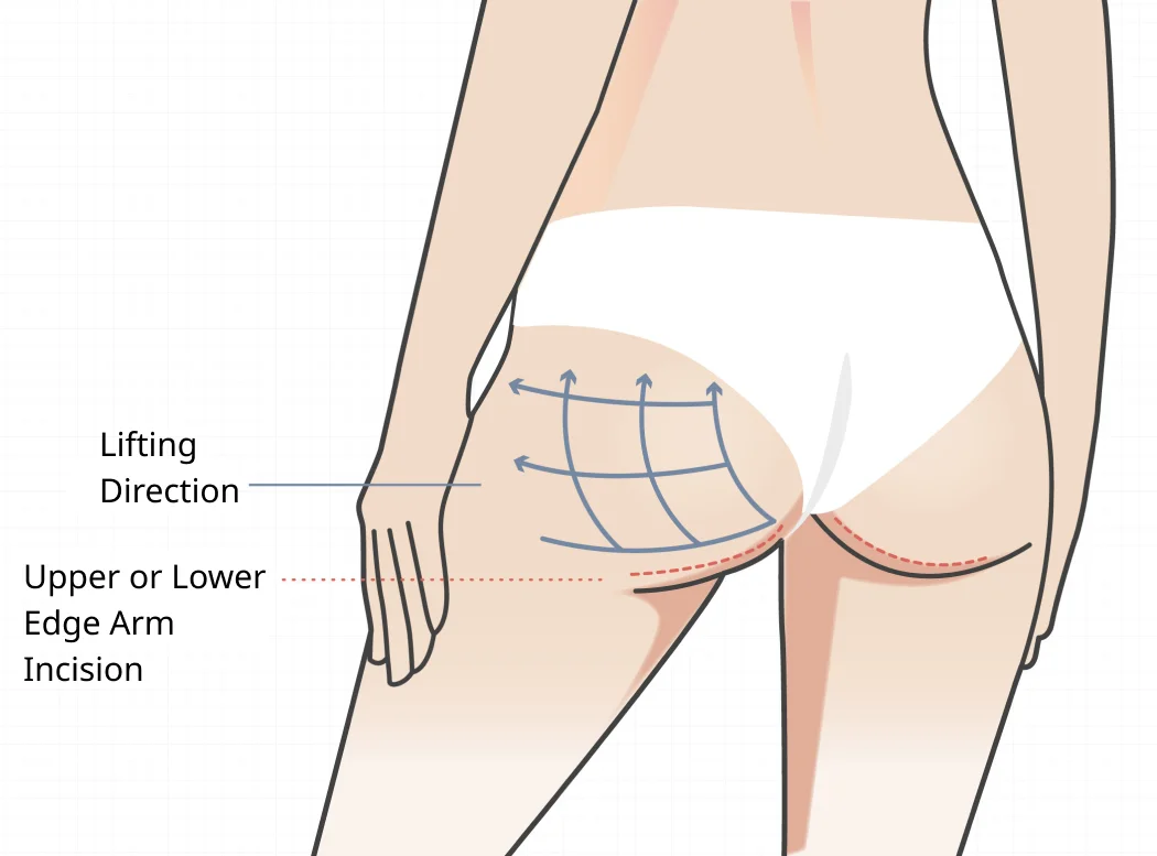 Buttock Lift Surgery Diagram