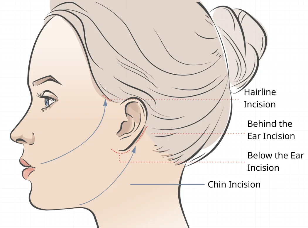 Mid and Lower Face Lift Surgery Diagram