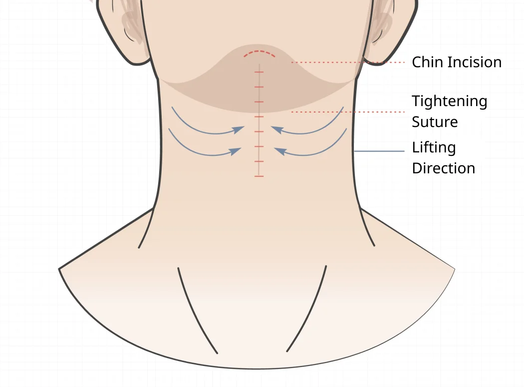 Neck Lift Surgery Diagram