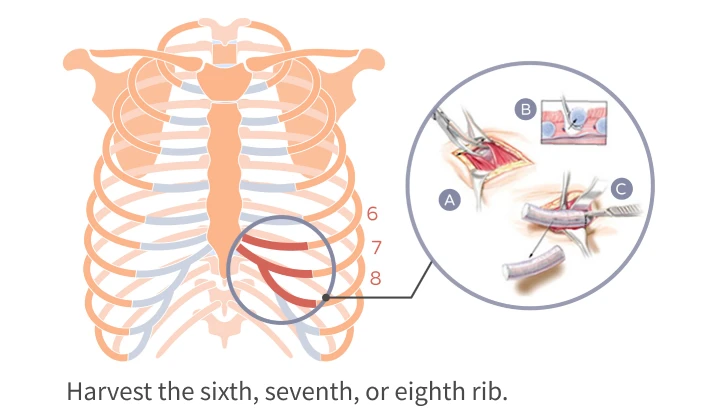 Rib cartilage is used as the implant material, taken from the lower edge of the right chest, specifically from the 6th, 7th, or 8th ribs, and sculpted into the desired shape for the nose.