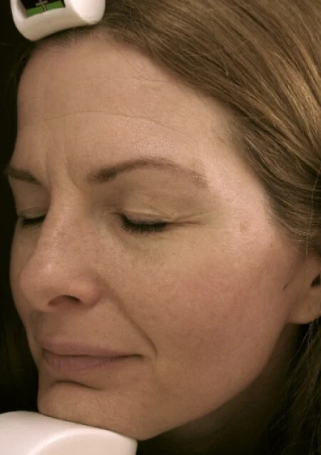 全臉除斑淨膚進度-3次治療